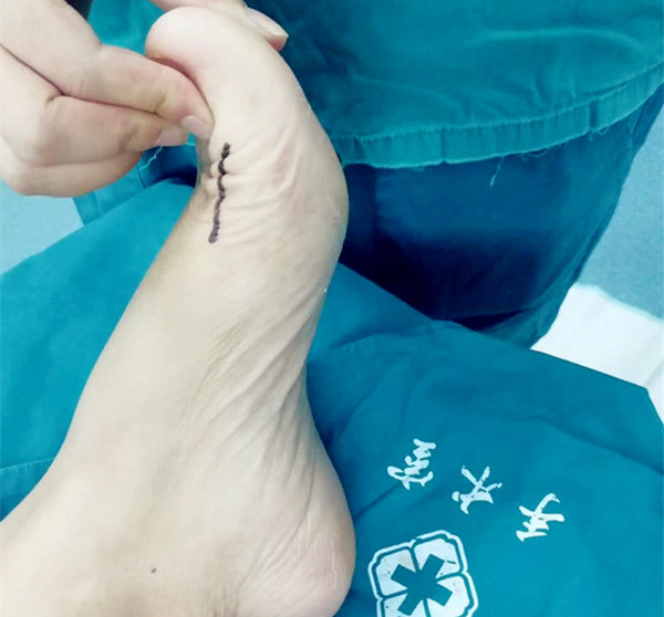 拇僵硬的swanson跖趾关节置换和跖骨远端背侧截骨治疗
